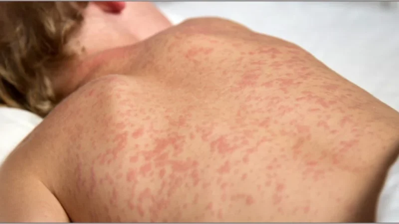 Novo caso de sarampo em São Paulo acende alerta nacional e reforça necessidade de ampliar vacinação