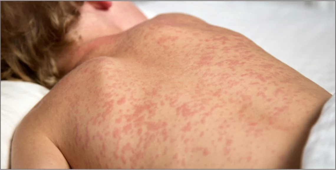 Novo caso de sarampo em São Paulo acende alerta nacional e reforça necessidade de ampliar vacinação