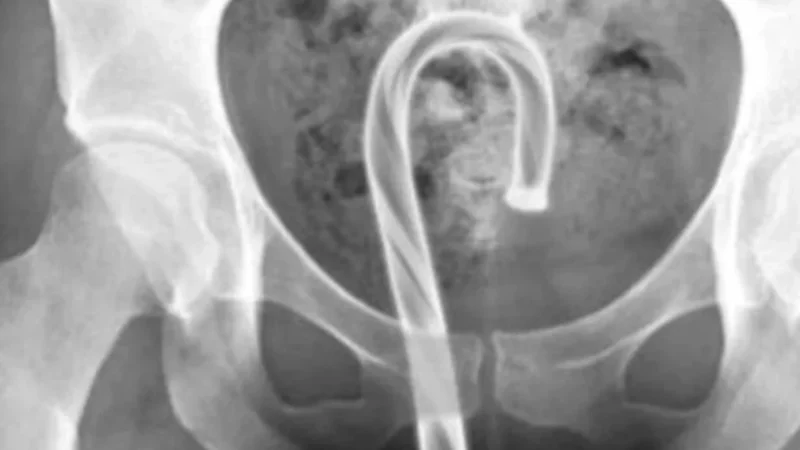 Alerta geral: risco grave à saúde com objetos inseridos nos órgãos sexuais