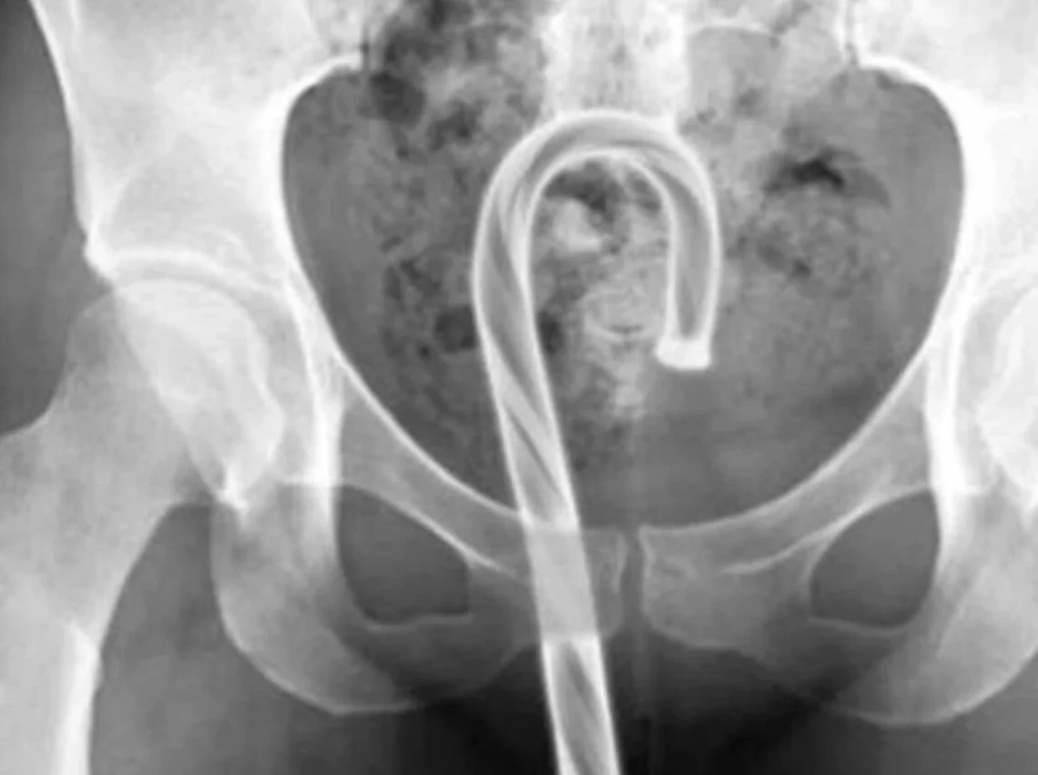 Alerta geral: risco grave à saúde com objetos inseridos nos órgãos sexuais